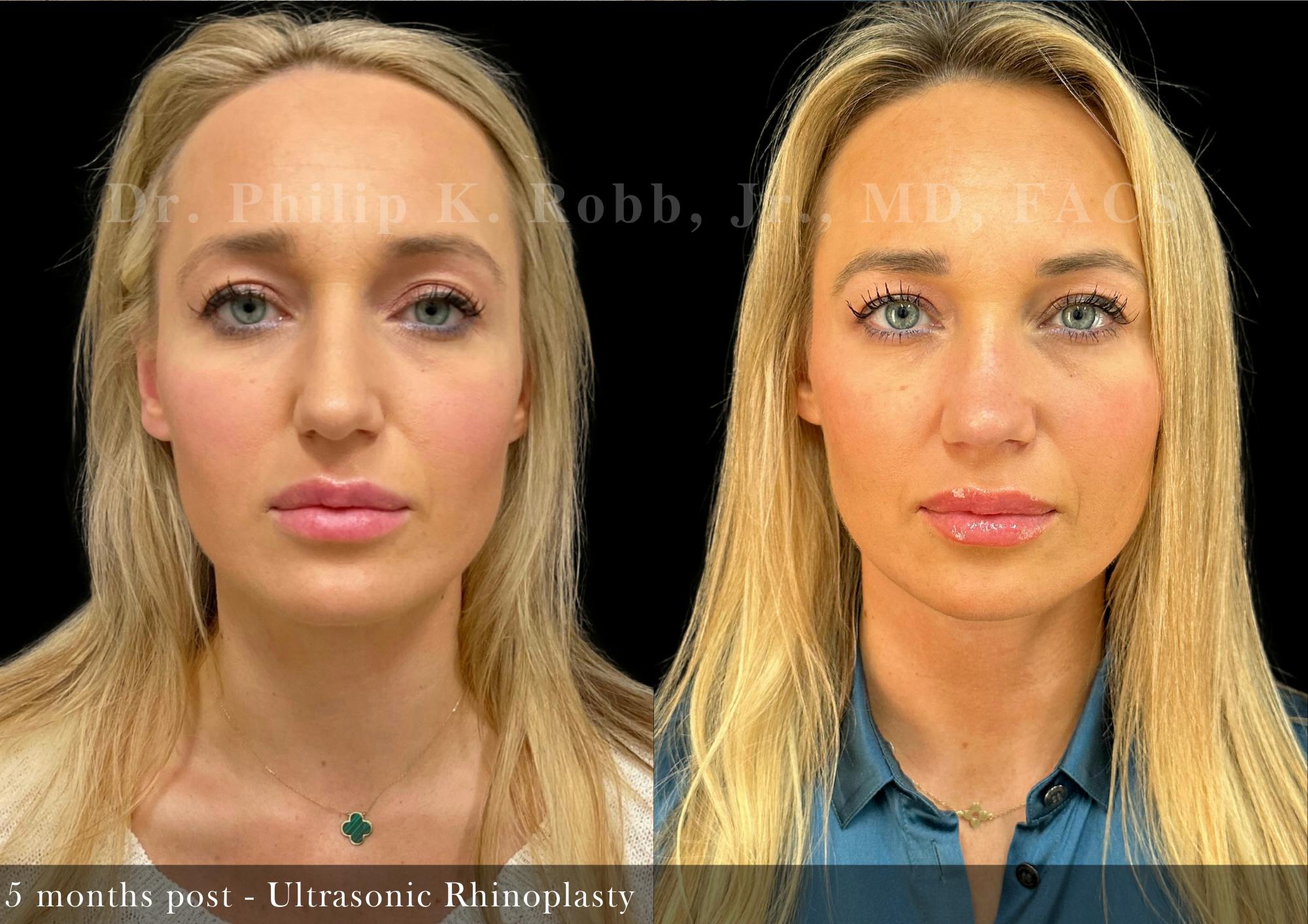 Ultrasonic Rhinoplasty Before & After Gallery - Patient 189943 - Image 4