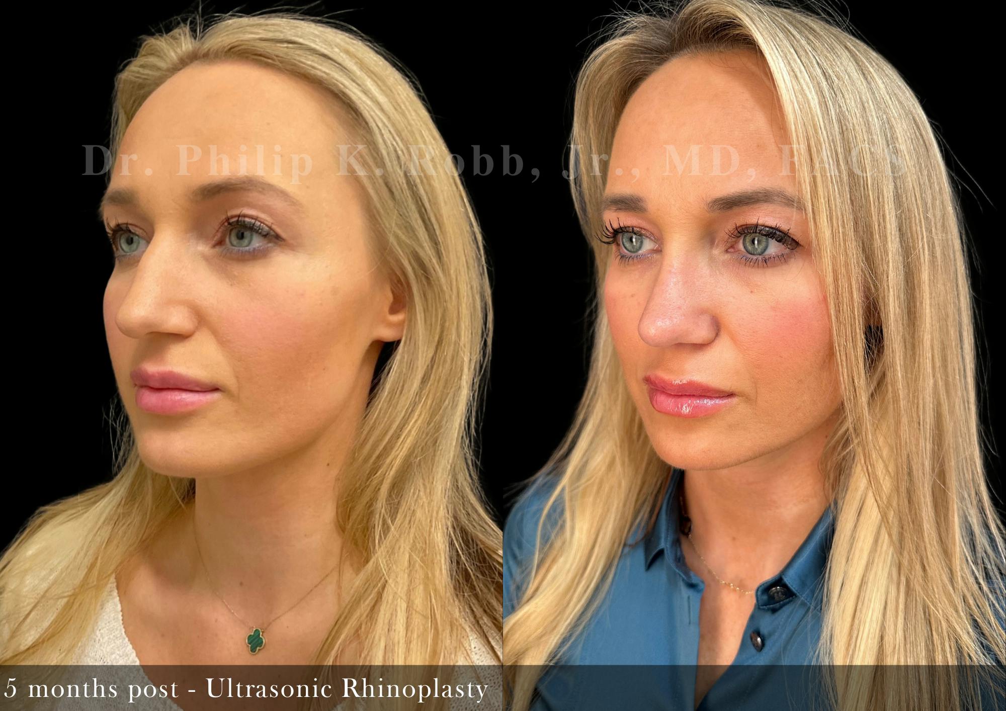 Ultrasonic Rhinoplasty Before & After Gallery - Patient 189943 - Image 5