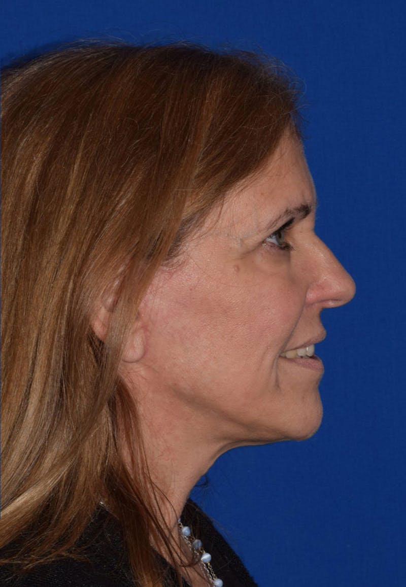 Facelift Before & After Gallery - Patient 319213 - Image 6