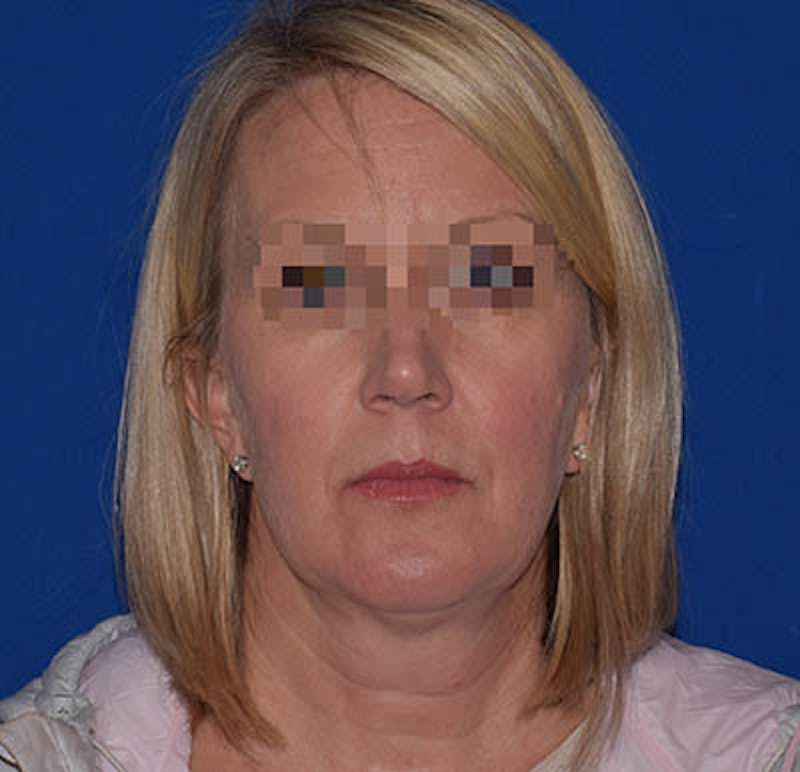 Facelift Before & After Gallery - Patient 369468 - Image 1