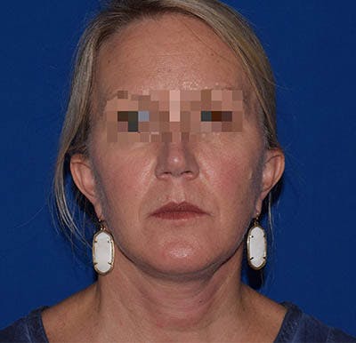 Facelift Before & After Gallery - Patient 369468 - Image 2