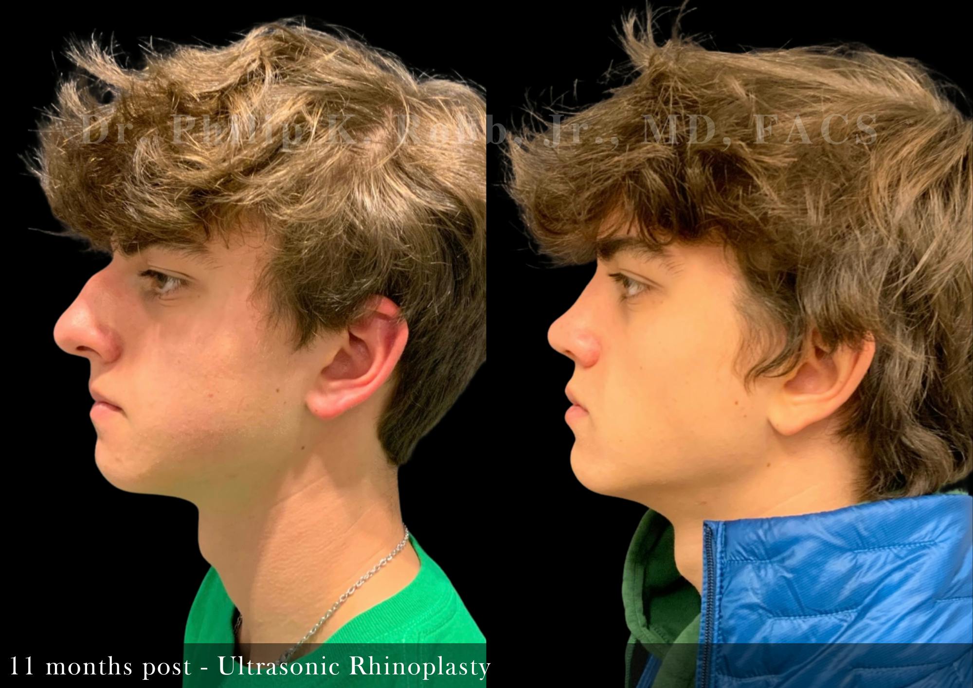Ultrasonic Rhinoplasty Before & After Gallery - Patient 229734 - Image 2
