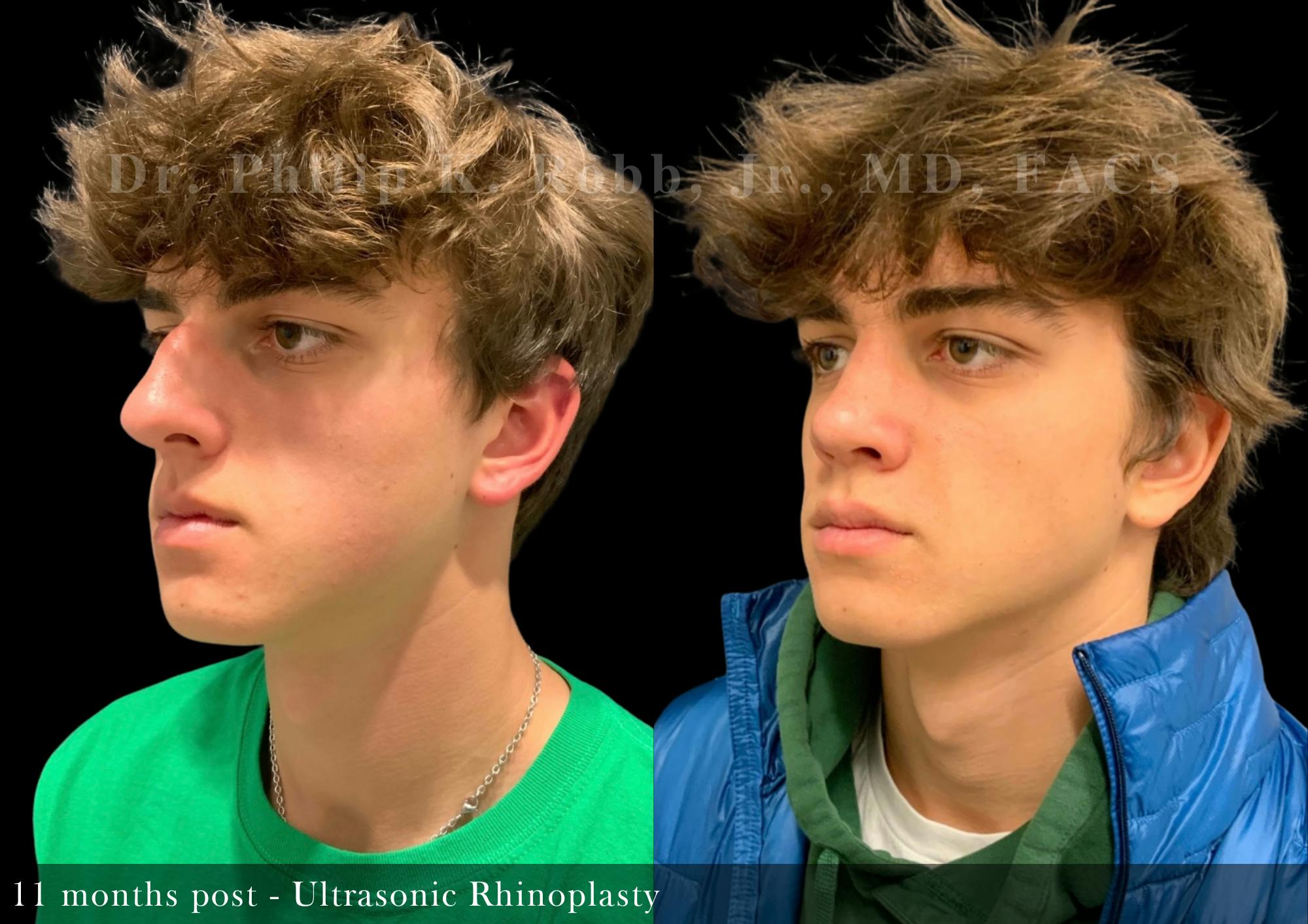 Ultrasonic Rhinoplasty Before & After Gallery - Patient 229734 - Image 3
