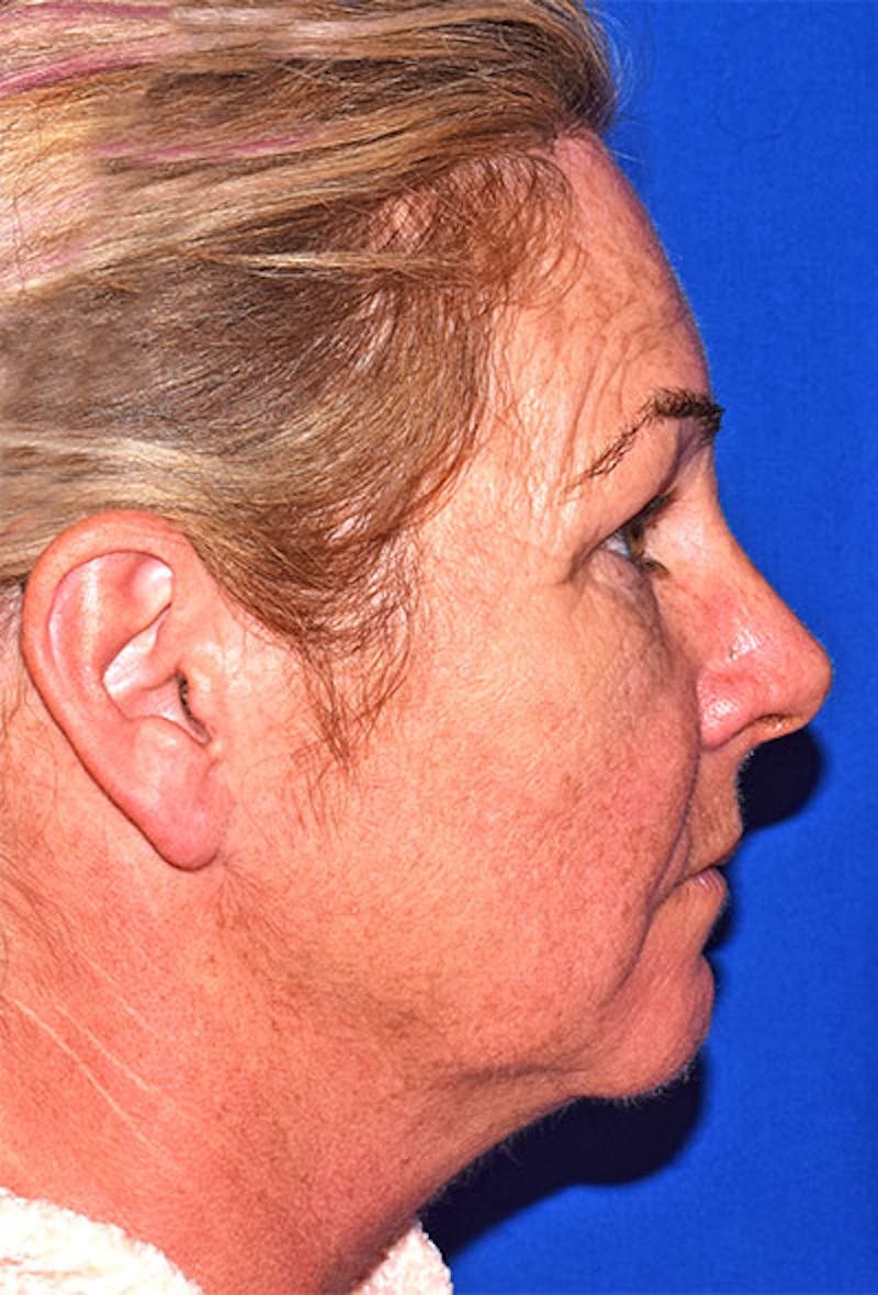 Facelift Before & After Gallery - Patient 871736 - Image 3