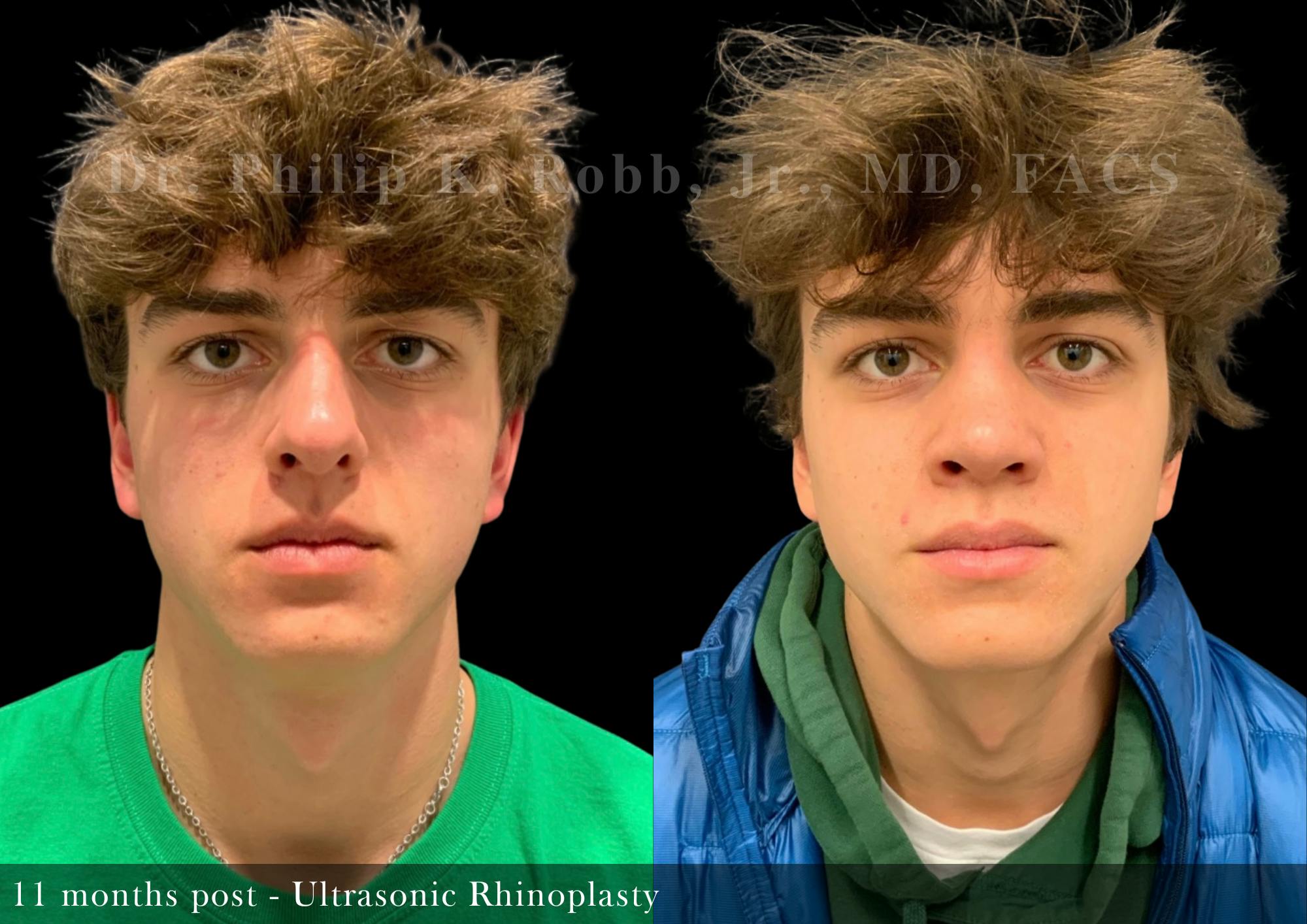 Ultrasonic Rhinoplasty Before & After Gallery - Patient 229734 - Image 4
