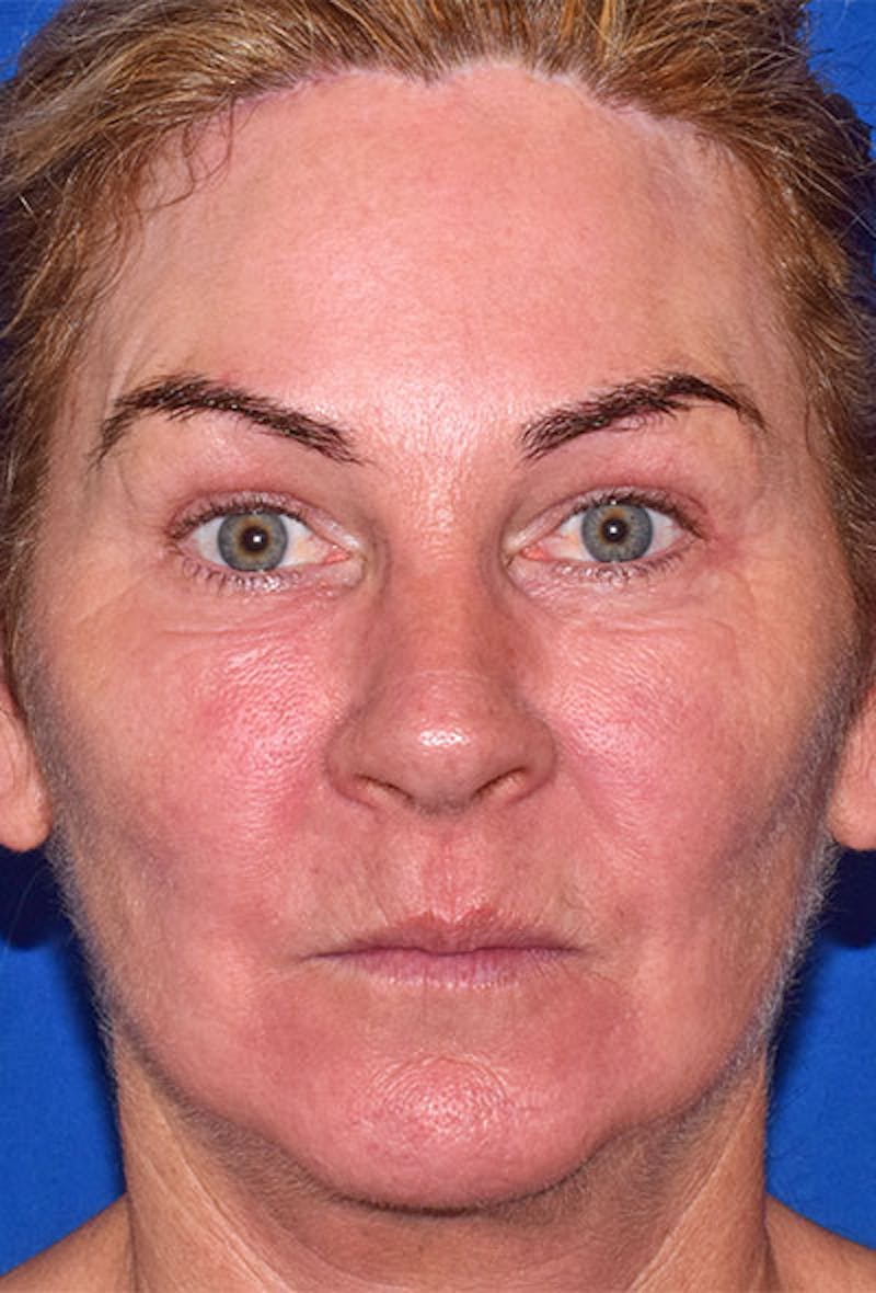 Facelift Before & After Gallery - Patient 871736 - Image 6