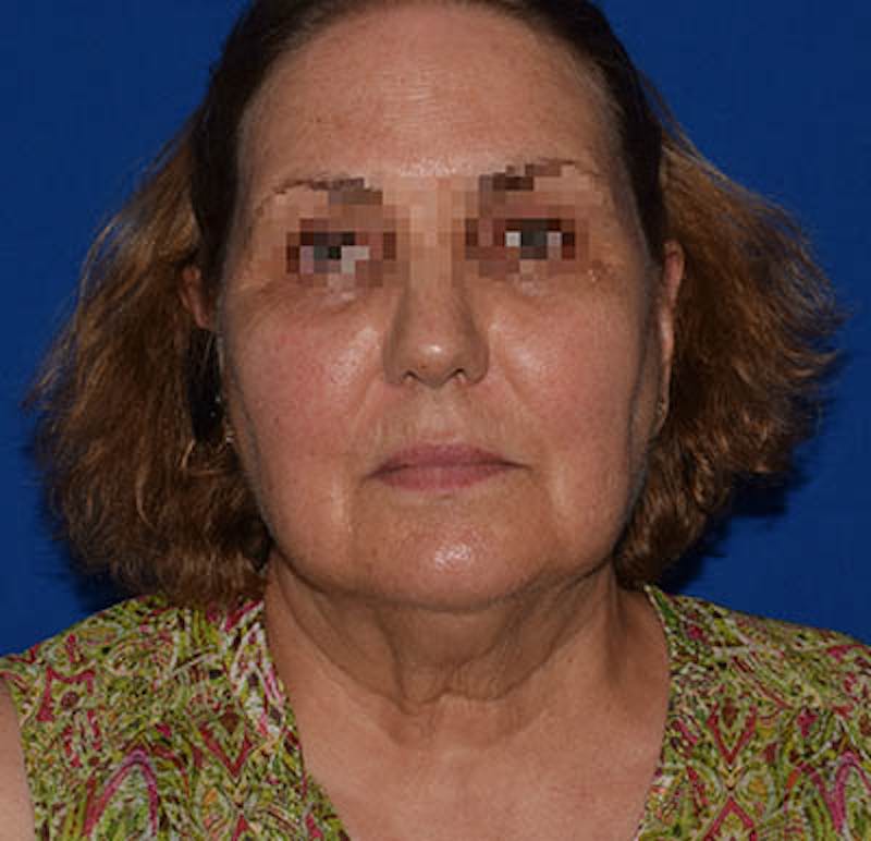 Facelift Before & After Gallery - Patient 102809 - Image 1