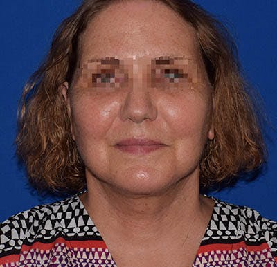 Facelift Before & After Gallery - Patient 102809 - Image 2