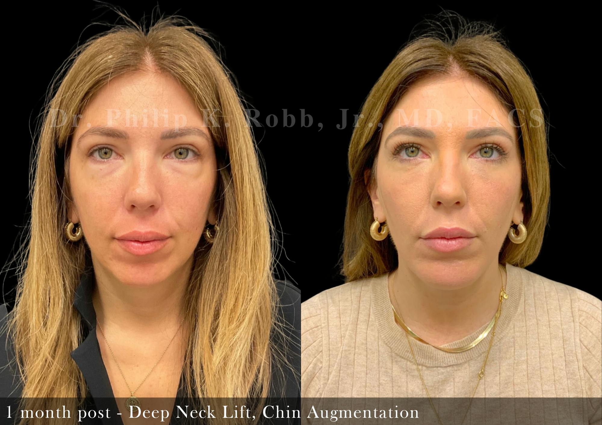 Neck Lift Before & After Gallery - Patient 231495 - Image 3