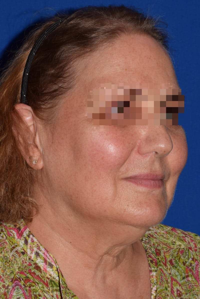 Facelift Before & After Gallery - Patient 102809 - Image 3