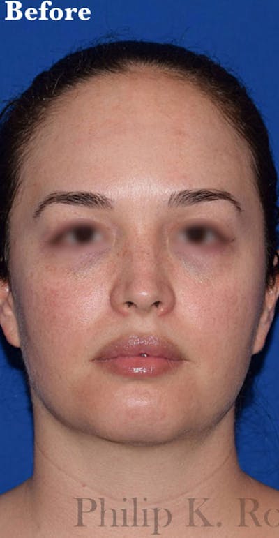 Facelift Before & After Gallery - Patient 432288 - Image 1