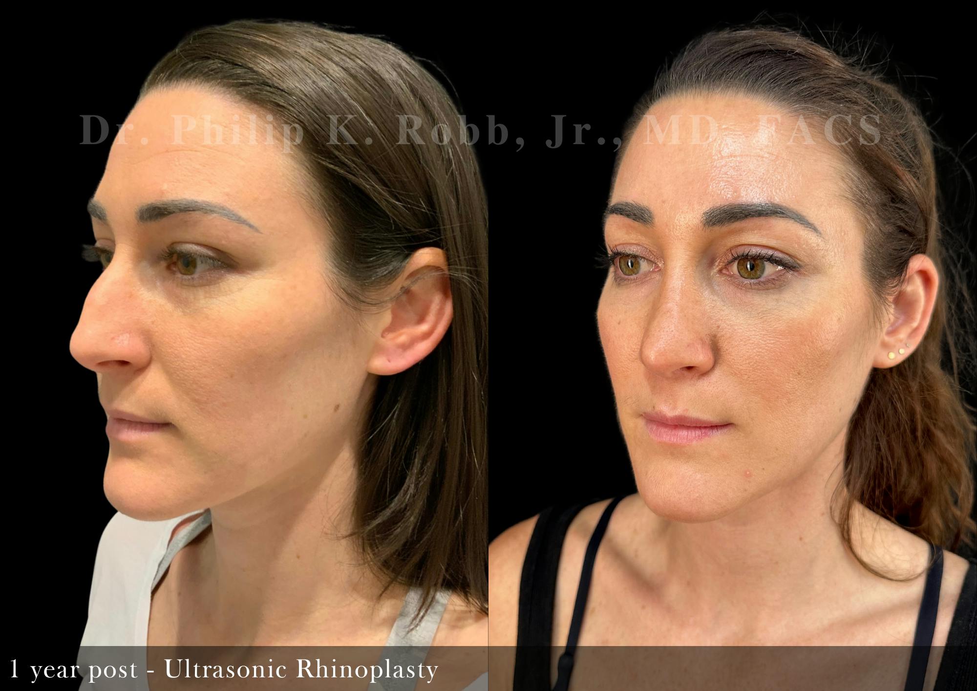Ultrasonic Rhinoplasty Before & After Gallery - Patient 103523 - Image 3