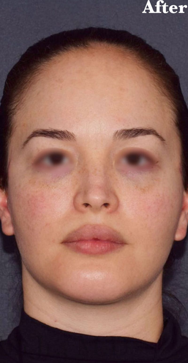 Facelift Before & After Gallery - Patient 432288 - Image 2