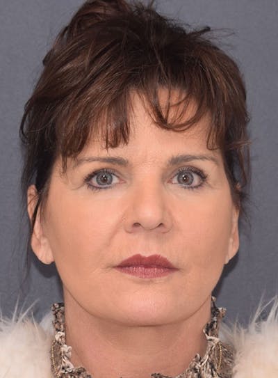 Neck Lift Before & After Gallery - Patient 367791 - Image 2