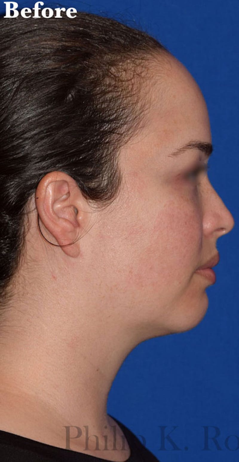 Facelift Before & After Gallery - Patient 432288 - Image 5