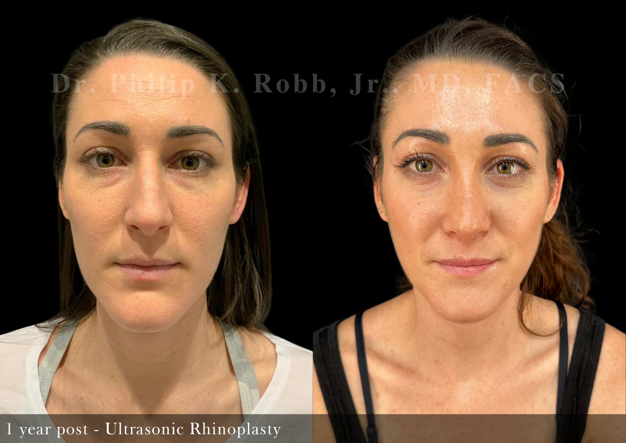 Ultrasonic Rhinoplasty Before & After Gallery - Patient 103523 - Image 5