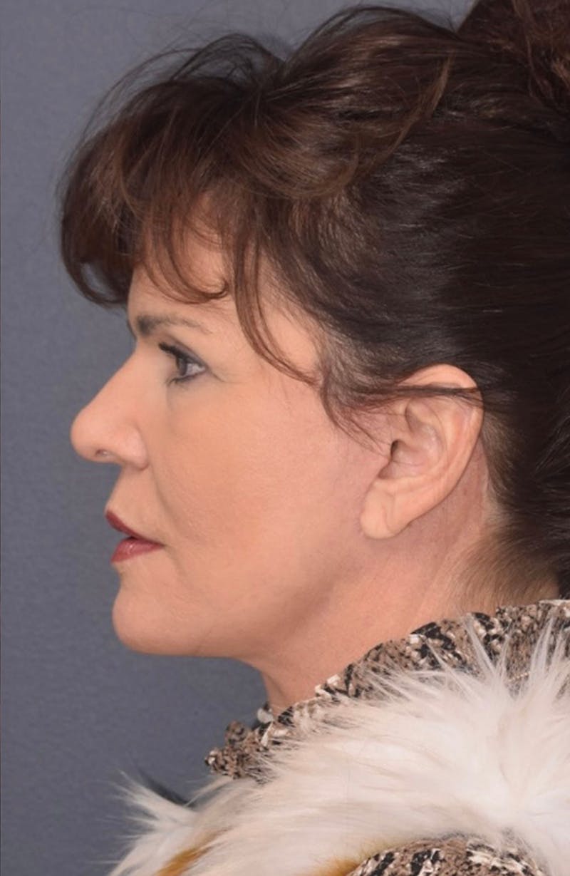 Neck Lift Before & After Gallery - Patient 367791 - Image 6