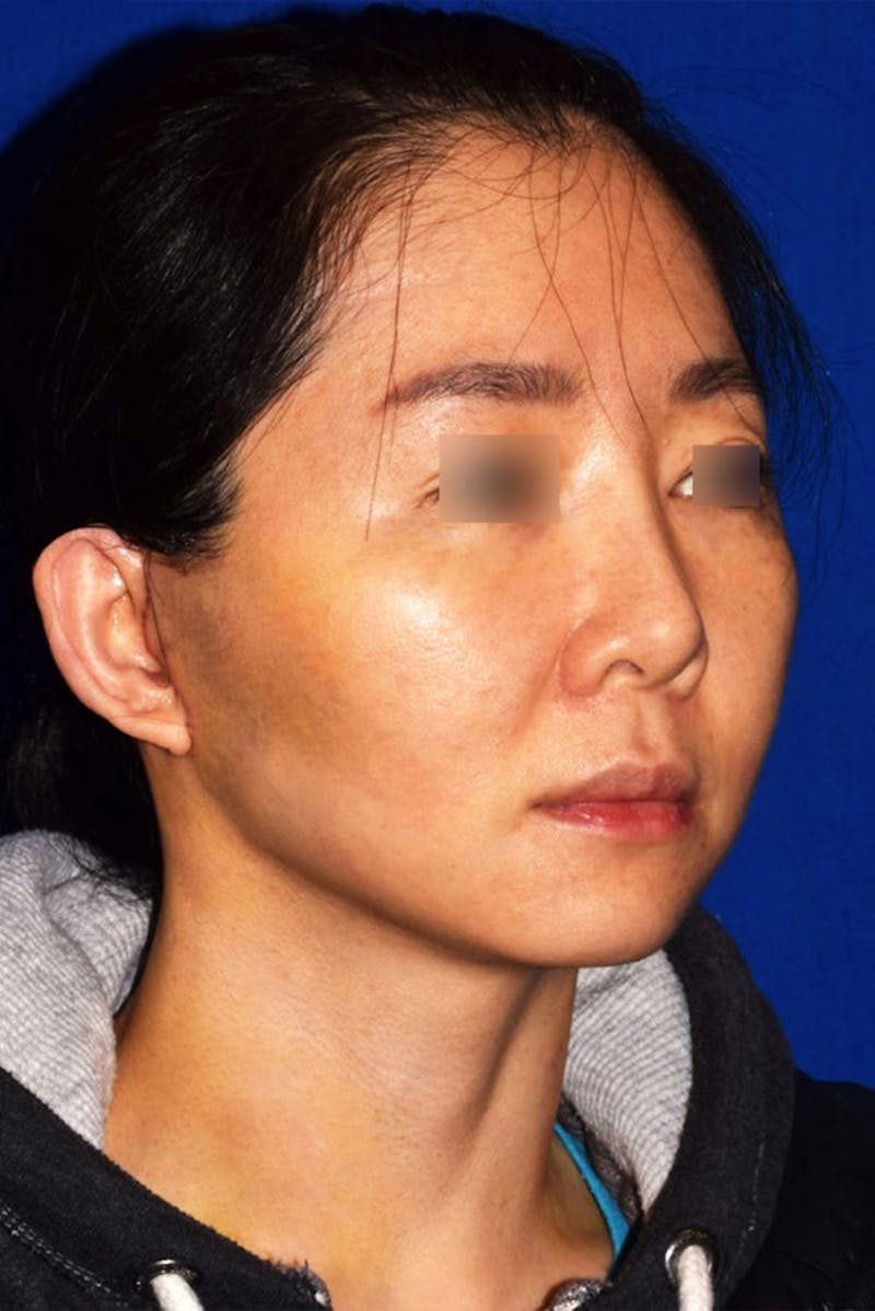 Facelift Before & After Gallery - Patient 279242 - Image 4