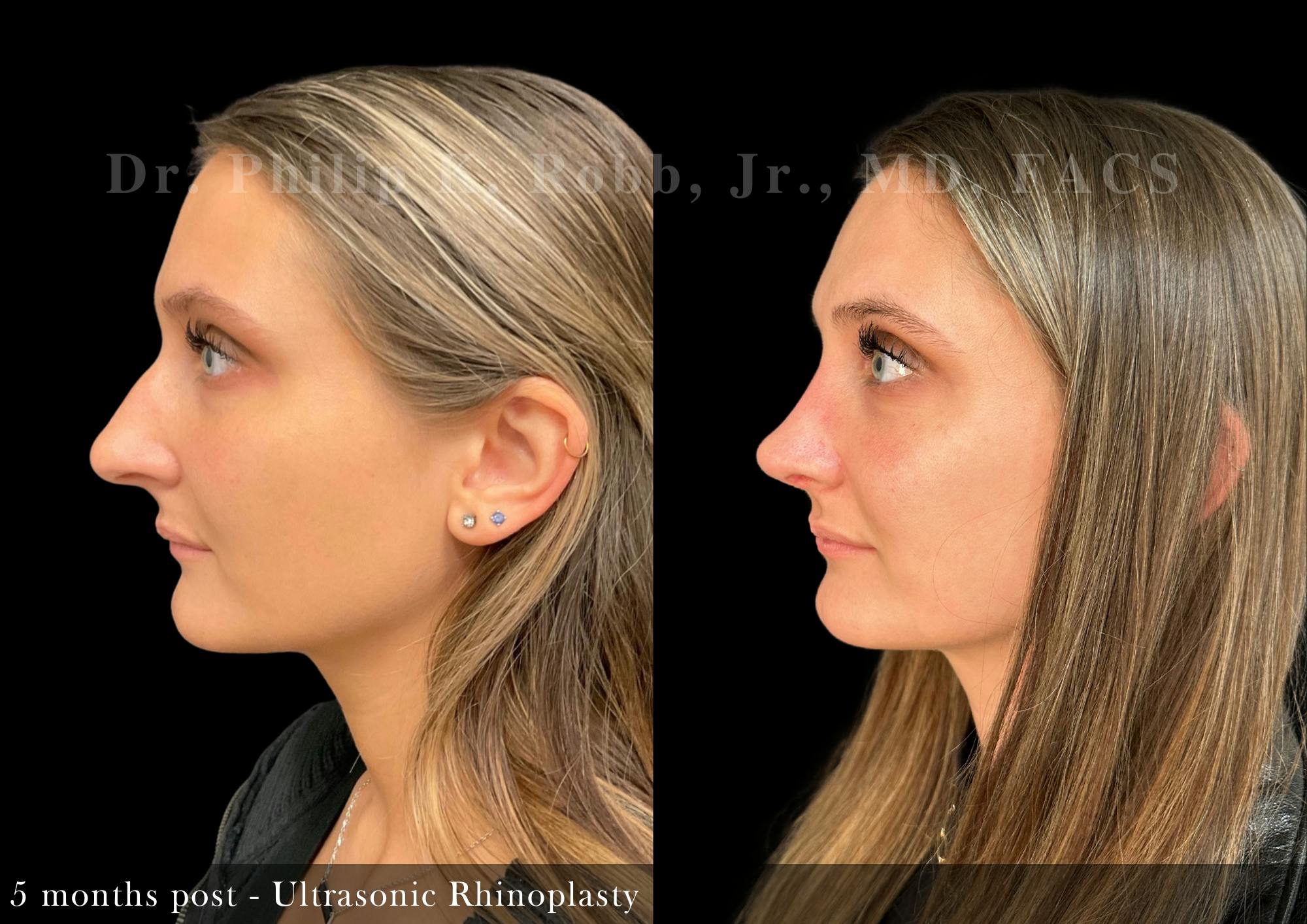 Ultrasonic Rhinoplasty Before & After Gallery - Patient 103671 - Image 5