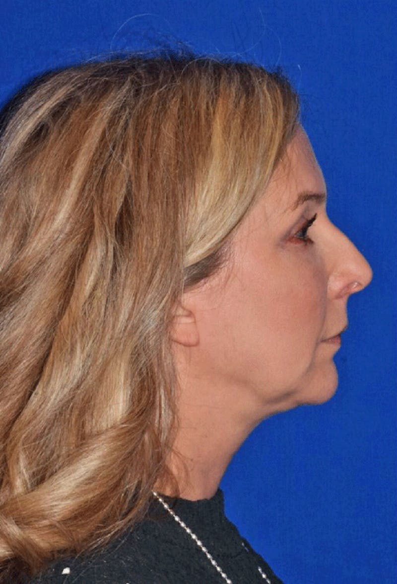 Neck Lift Before & After Gallery - Patient 284673 - Image 5