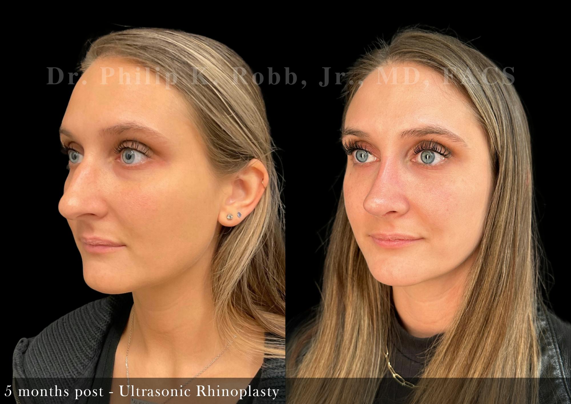 Ultrasonic Rhinoplasty Before & After Gallery - Patient 103671 - Image 4