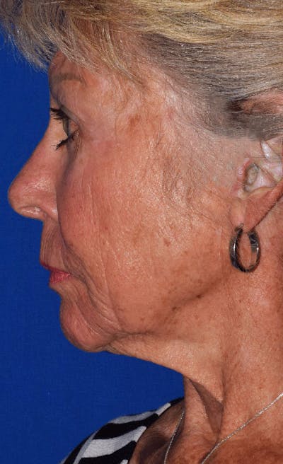 Neck Lift Before & After Gallery - Patient 108899 - Image 1