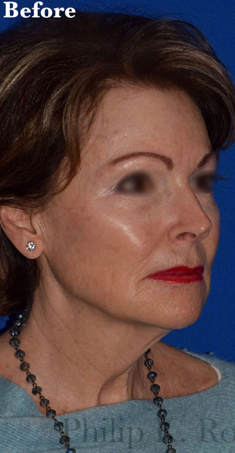 Facelift Before & After Gallery - Patient 335167 - Image 1