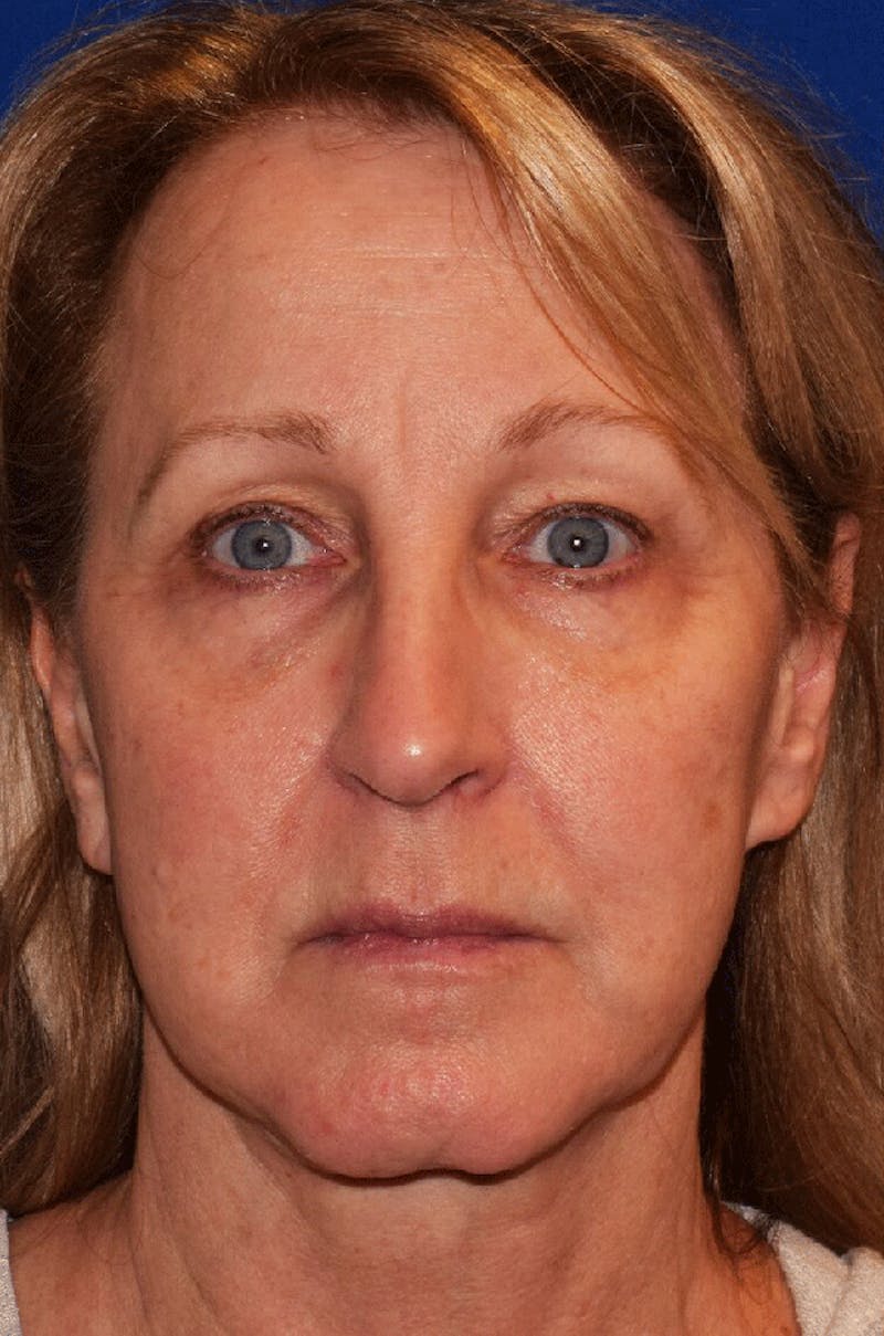 Neck Lift Before & After Gallery - Patient 297751 - Image 1