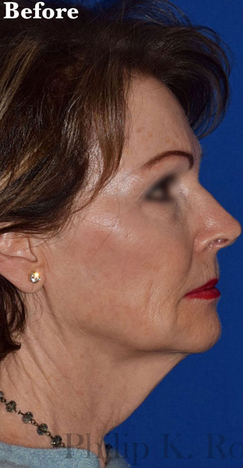 Facelift Before & After Gallery - Patient 335167 - Image 3