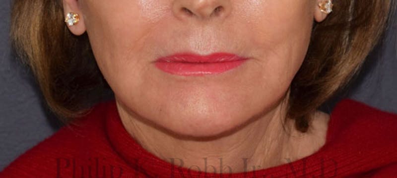 Facelift Before & After Gallery - Patient 335167 - Image 6