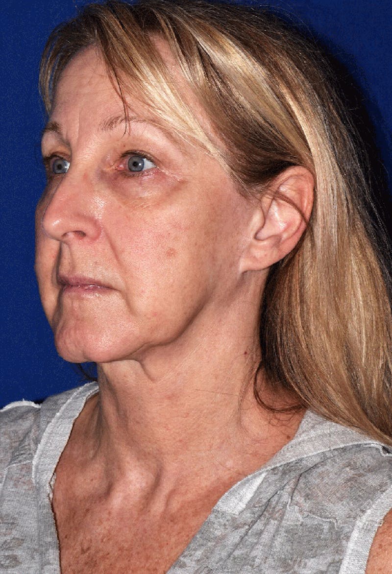 Neck Lift Before & After Gallery - Patient 297751 - Image 5