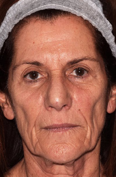 Facelift Before & After Gallery - Patient 151973 - Image 1