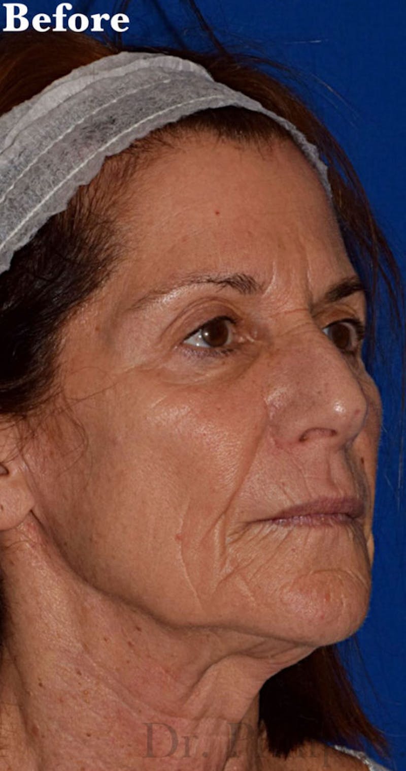 Facelift Before & After Gallery - Patient 151973 - Image 3