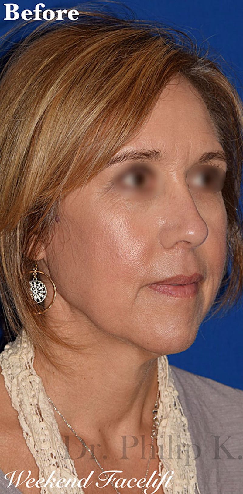 Facelift Before & After Gallery - Patient 701969 - Image 1
