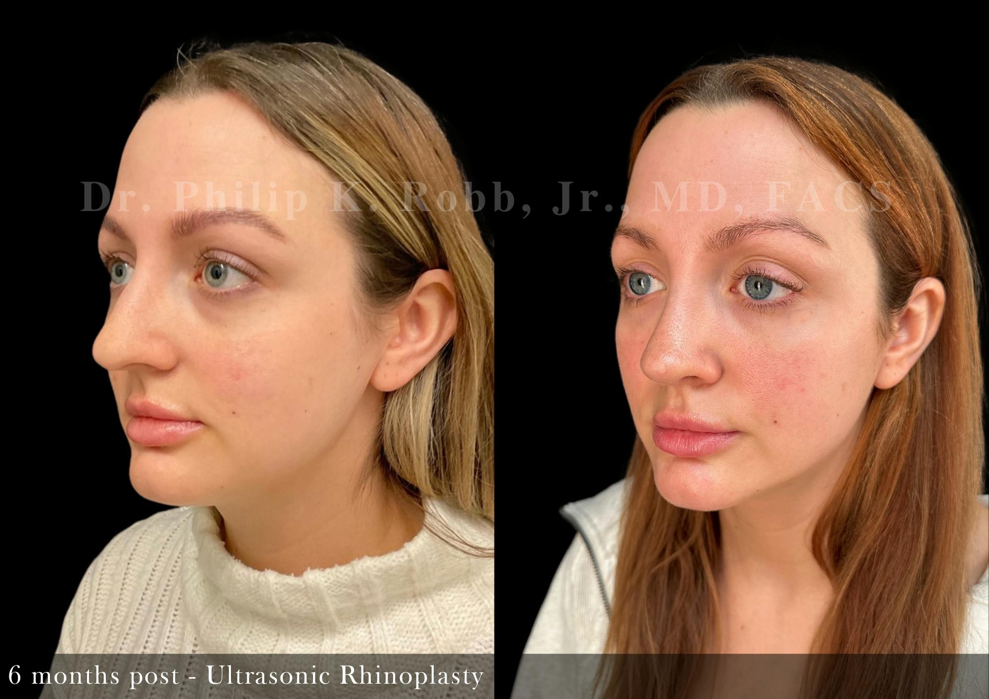 Ultrasonic Rhinoplasty Before & After Gallery - Patient 555264 - Image 3