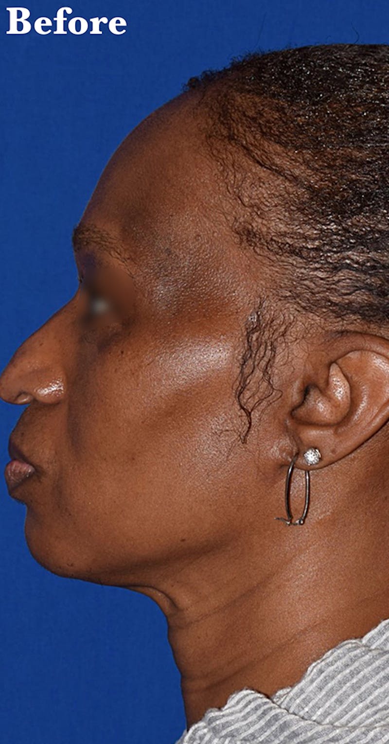 Facelift Before & After Gallery - Patient 233195 - Image 1