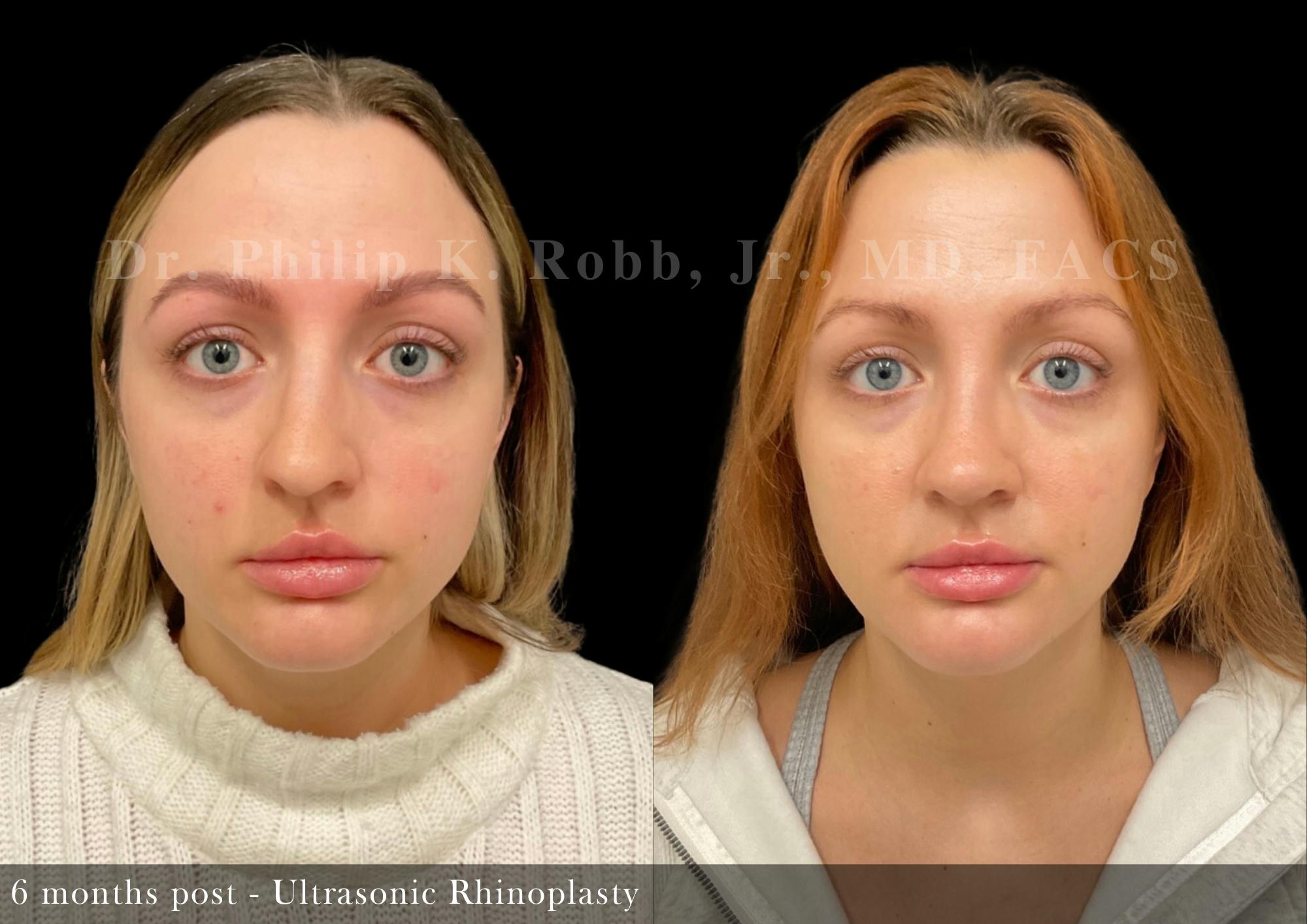 Ultrasonic Rhinoplasty Before & After Gallery - Patient 555264 - Image 4