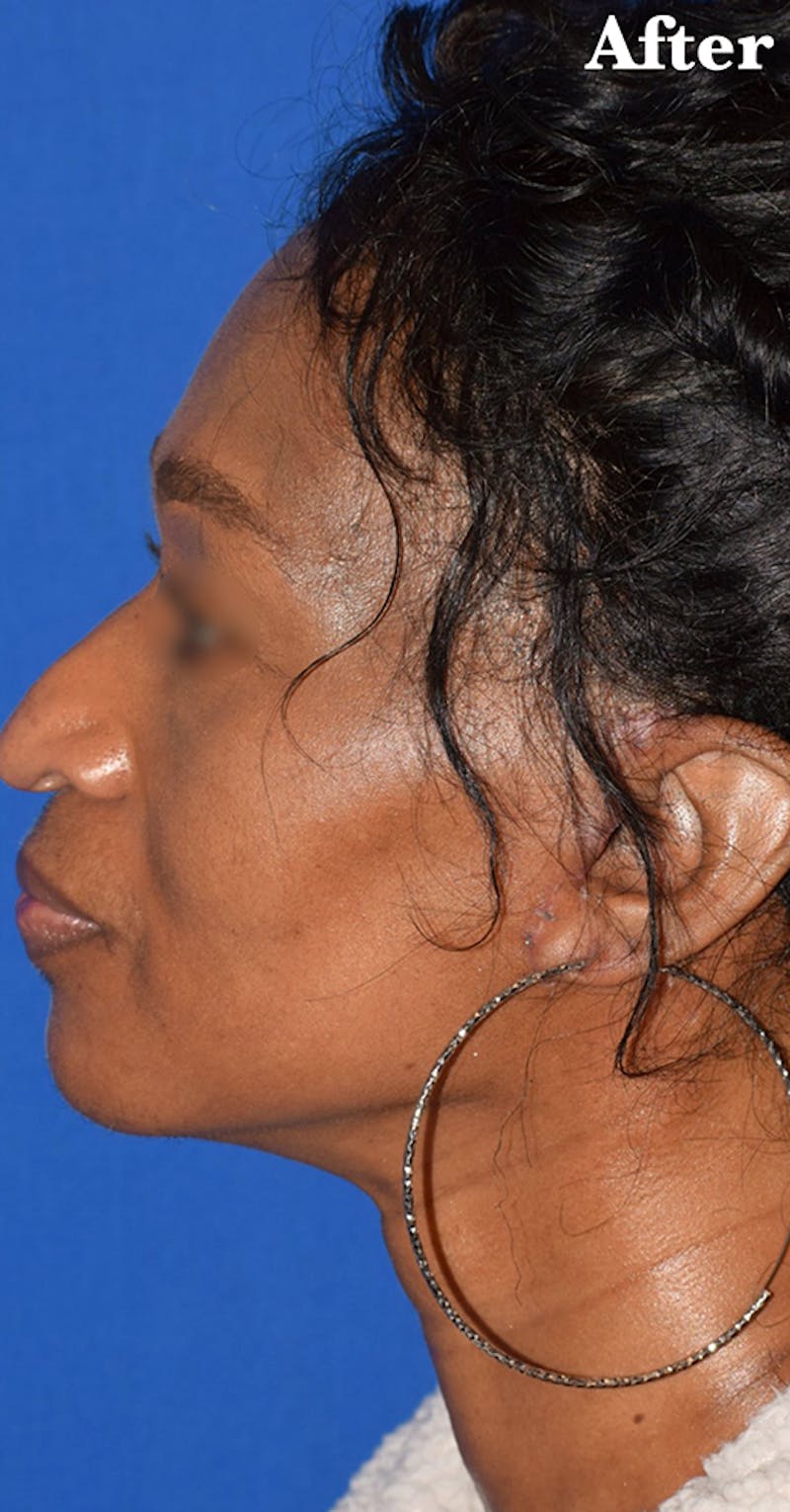 Facelift Before & After Gallery - Patient 233195 - Image 2