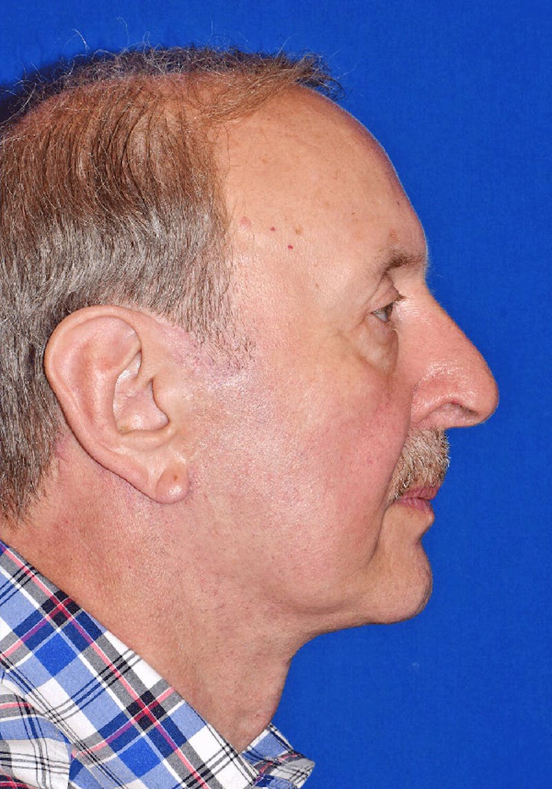 Neck Lift Before & After Gallery - Patient 370370 - Image 2