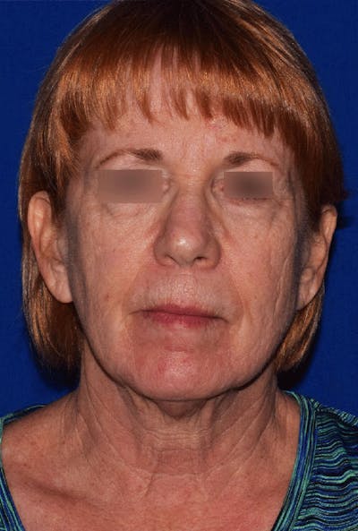 Neck Lift Before & After Gallery - Patient 376001 - Image 1