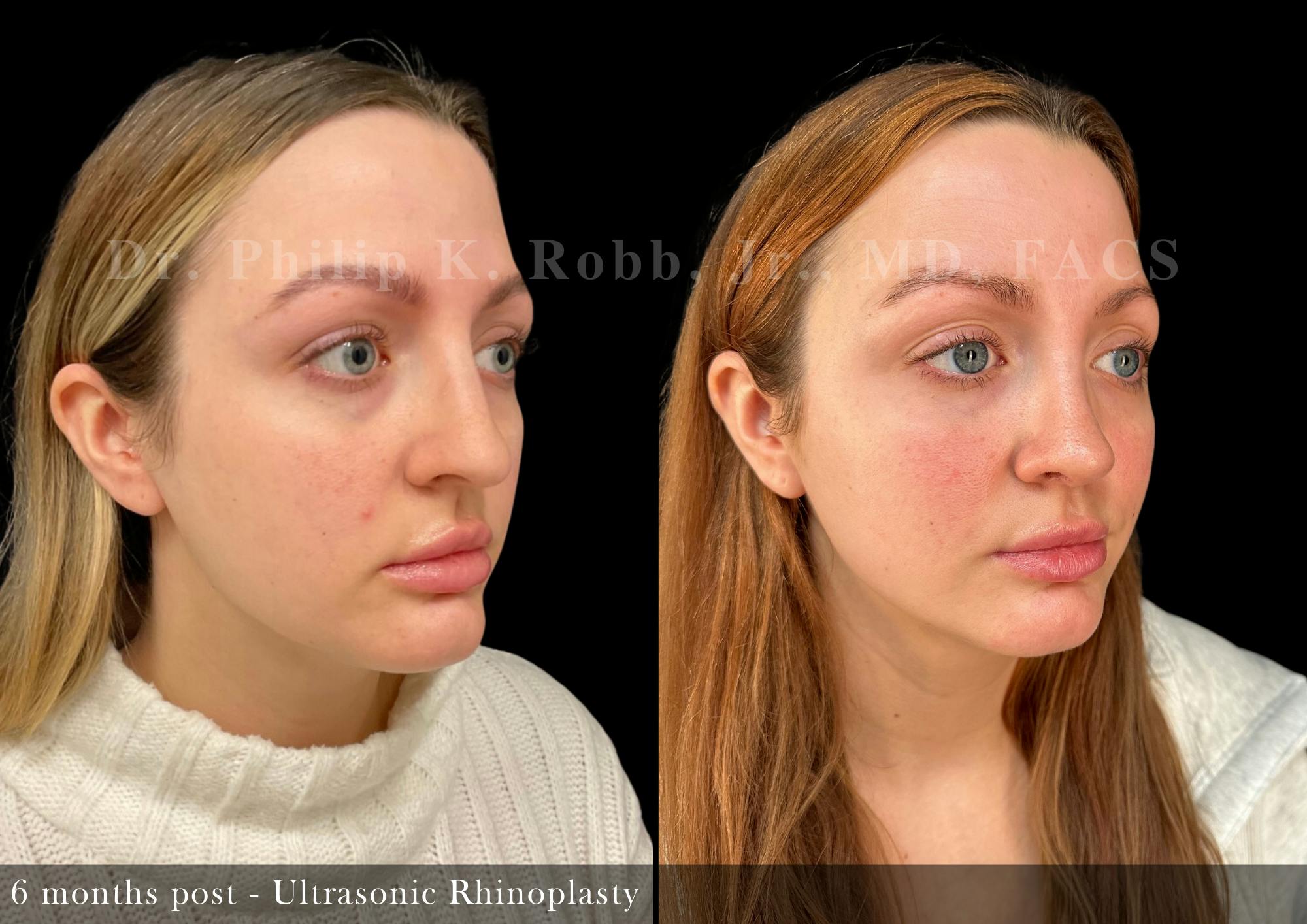 Ultrasonic Rhinoplasty Before & After Gallery - Patient 555264 - Image 5