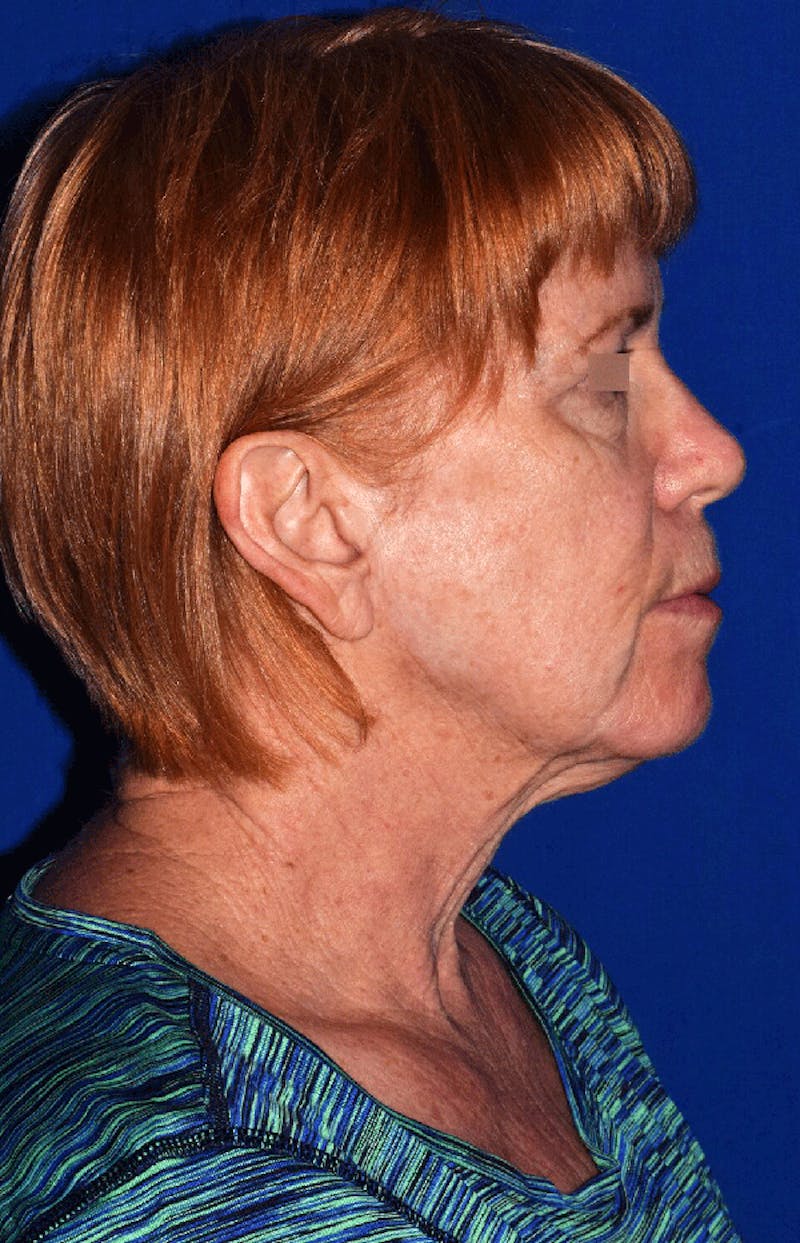 Neck Lift Before & After Gallery - Patient 376001 - Image 3