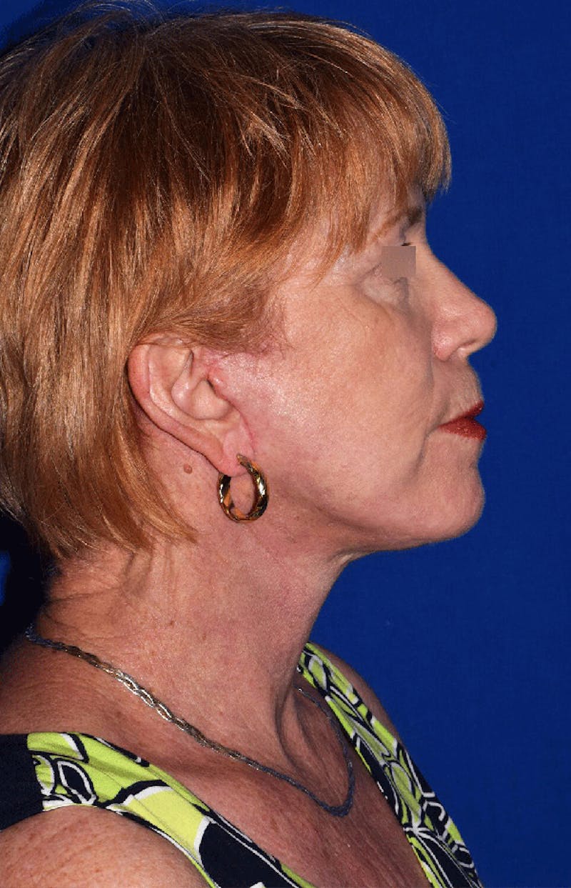 Neck Lift Before & After Gallery - Patient 376001 - Image 4