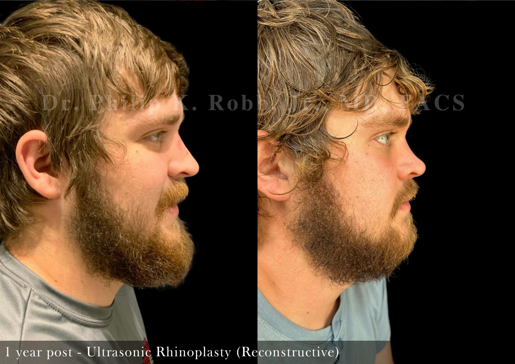 Ultrasonic Rhinoplasty Before & After Gallery - Patient 896389 - Image 1