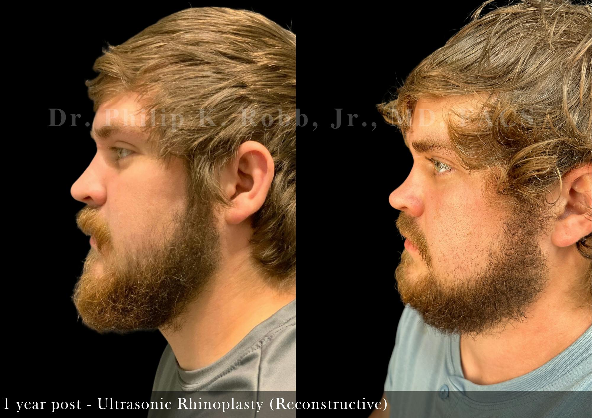 Ultrasonic Rhinoplasty Before & After Gallery - Patient 896389 - Image 2