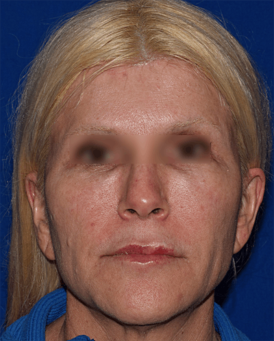 Neck Lift Before & After Gallery - Patient 393416 - Image 1