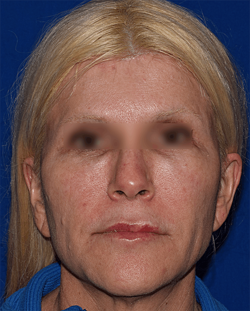 Neck Lift Before & After Gallery - Patient 393416 - Image 1