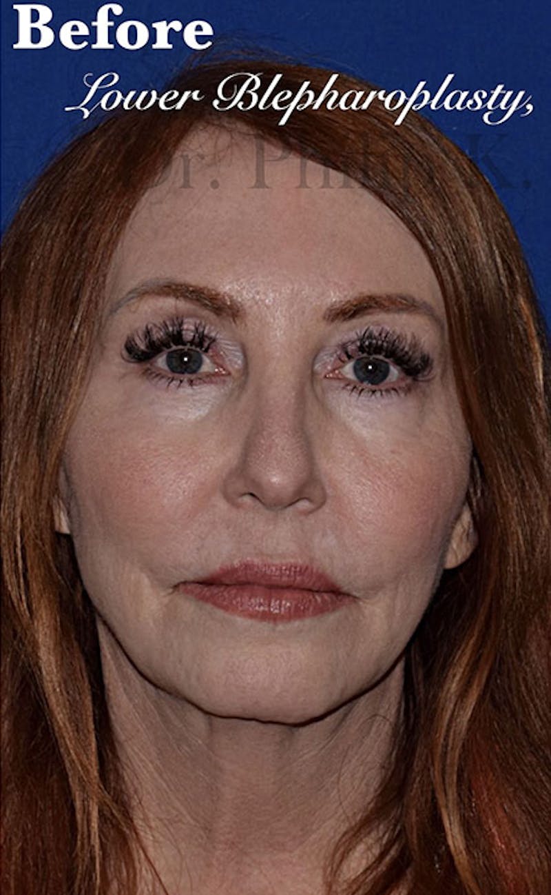 Facelift Before & After Gallery - Patient 153420 - Image 1