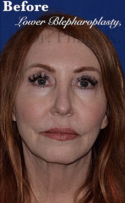 Facelift Before & After Gallery - Patient 153420 - Image 1