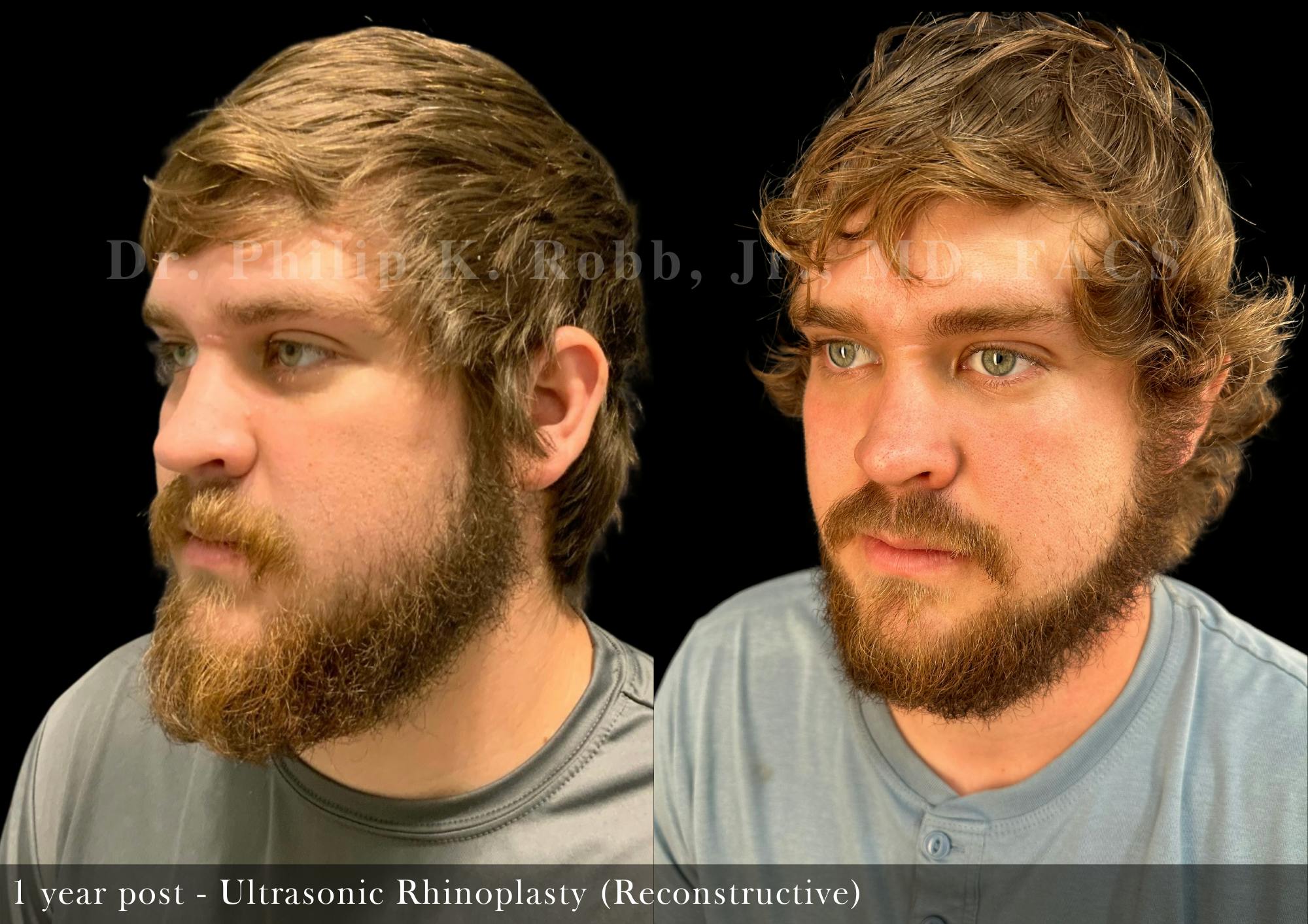 Ultrasonic Rhinoplasty Before & After Gallery - Patient 896389 - Image 3